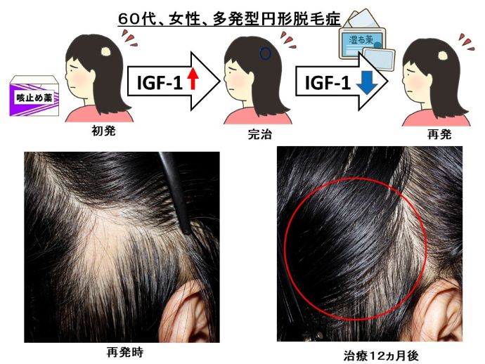 円形脱毛症　病院